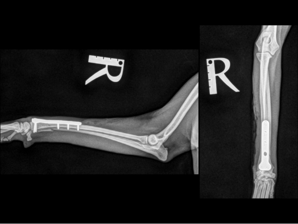 インプラントによる内固定後のレントゲン写真